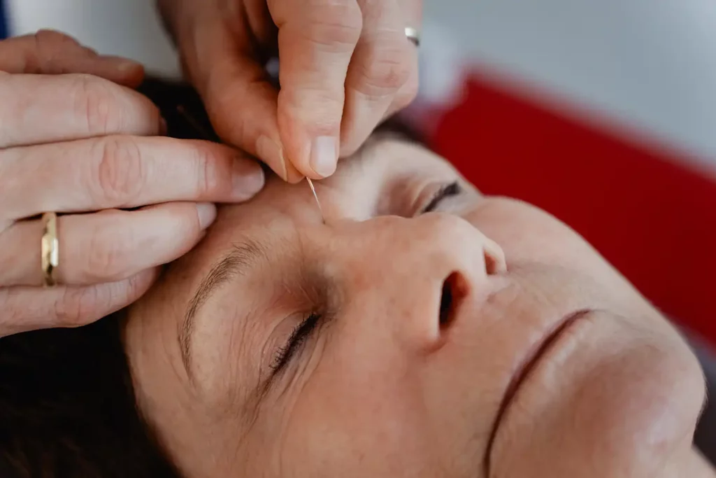 Nahaufnahme von Patientin, die Akupunkturnadel von Therapeutin an Stirn gesetzt bekommt